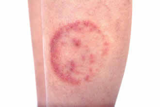 pinworm rash on bottom