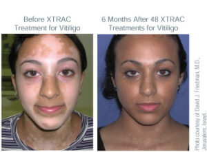 XTRAC - Excimer Laser - Center For Dermatology