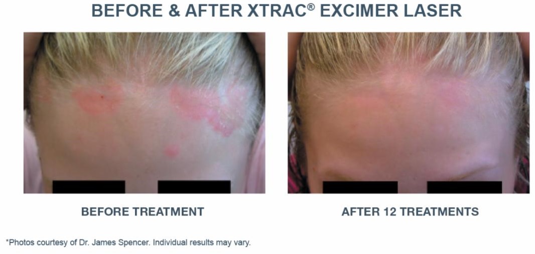 Before after Scalp Psoriasis with X-Trac